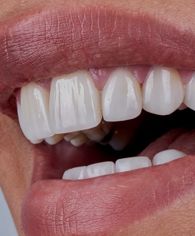 Treatment -  Smiles & Beyond