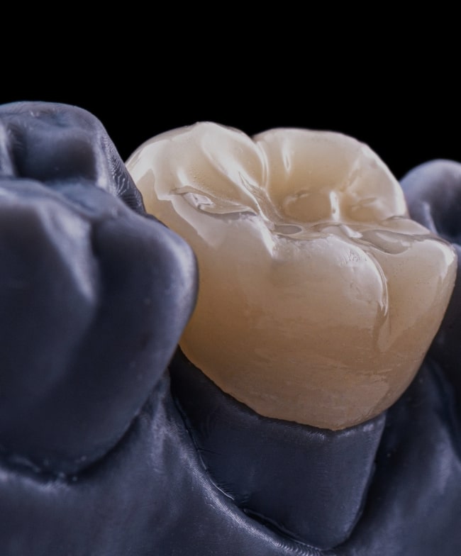 Treatment -  Smiles & Beyond