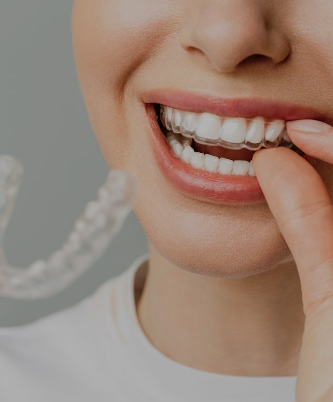 Treatment Category - Smiles & Beyond
