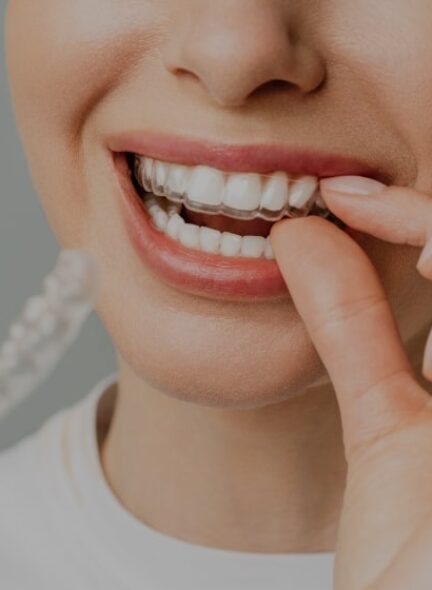 Porcelain Veneers Big