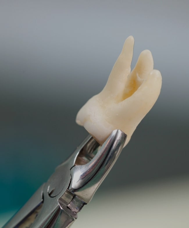 Treatment -  Smiles & Beyond